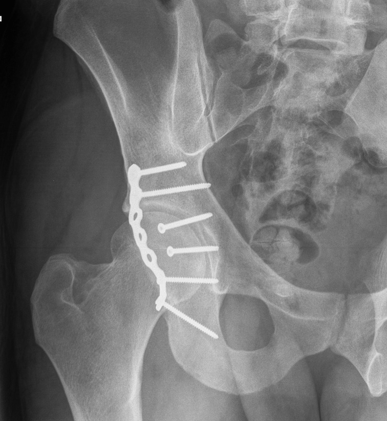 Acetabulum Posterior Wall Plating 2